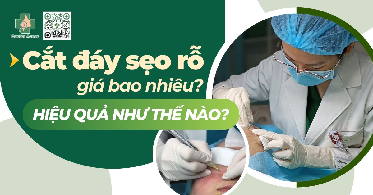 cắt đáy sẹo rỗ giá bao nhiêu