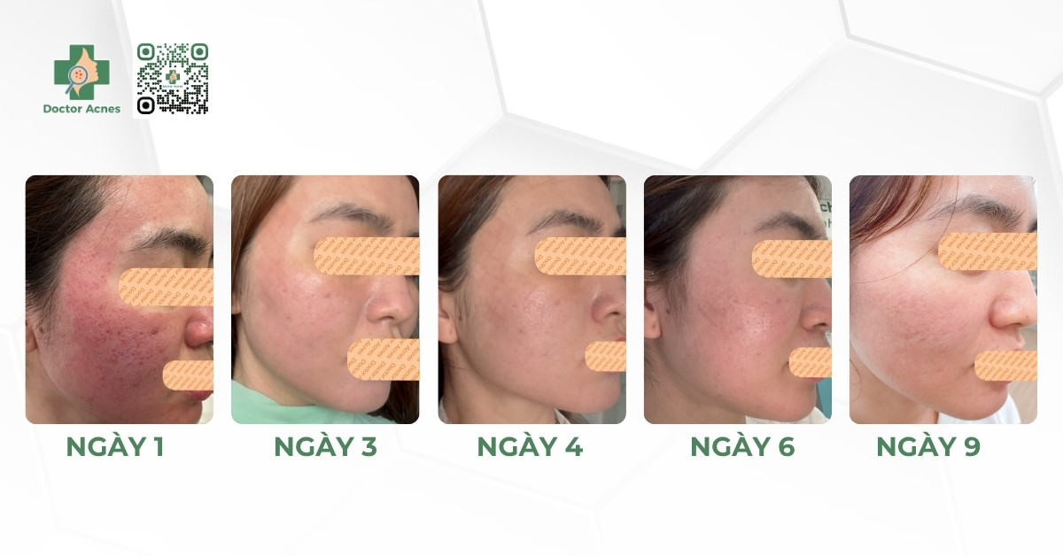 Quá trình phục hồi sau laser fractional co2