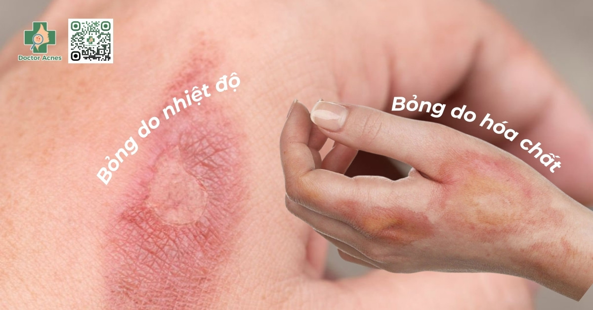 vết bỏng bị thâm đen phải làm sao