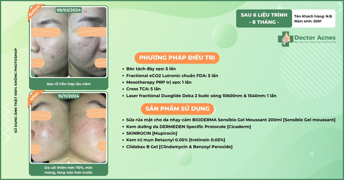 ca lâm sàng điều trị sẹo rỗ thành công