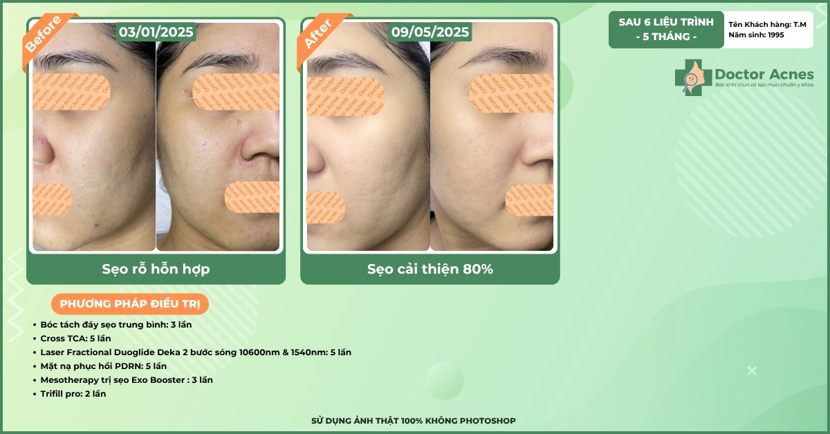 ca lâm sàng điều trị sẹo rỗ thành công
