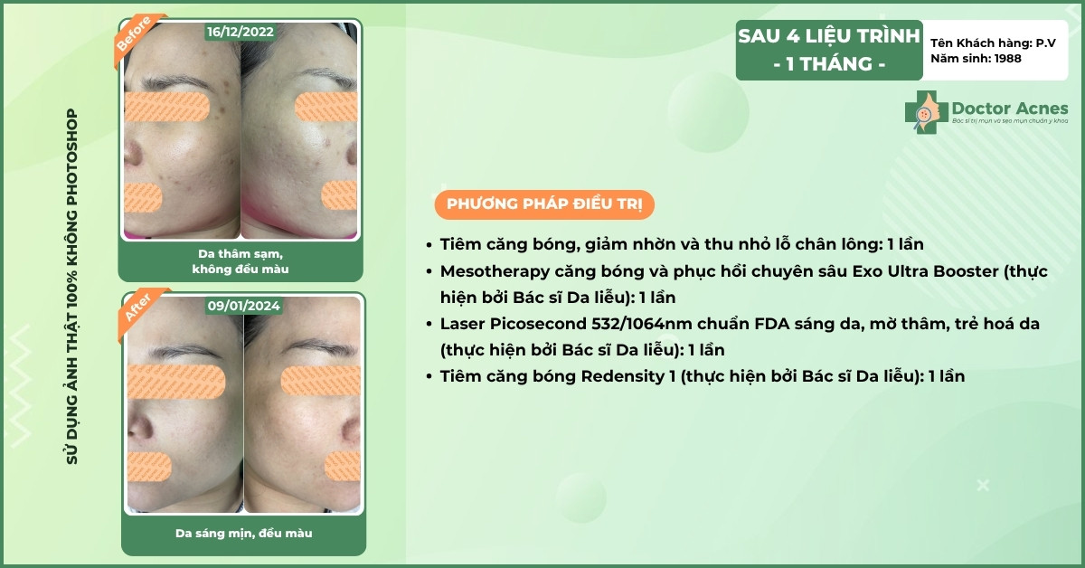 ca lâm sàng điều trị thâm với laser pico