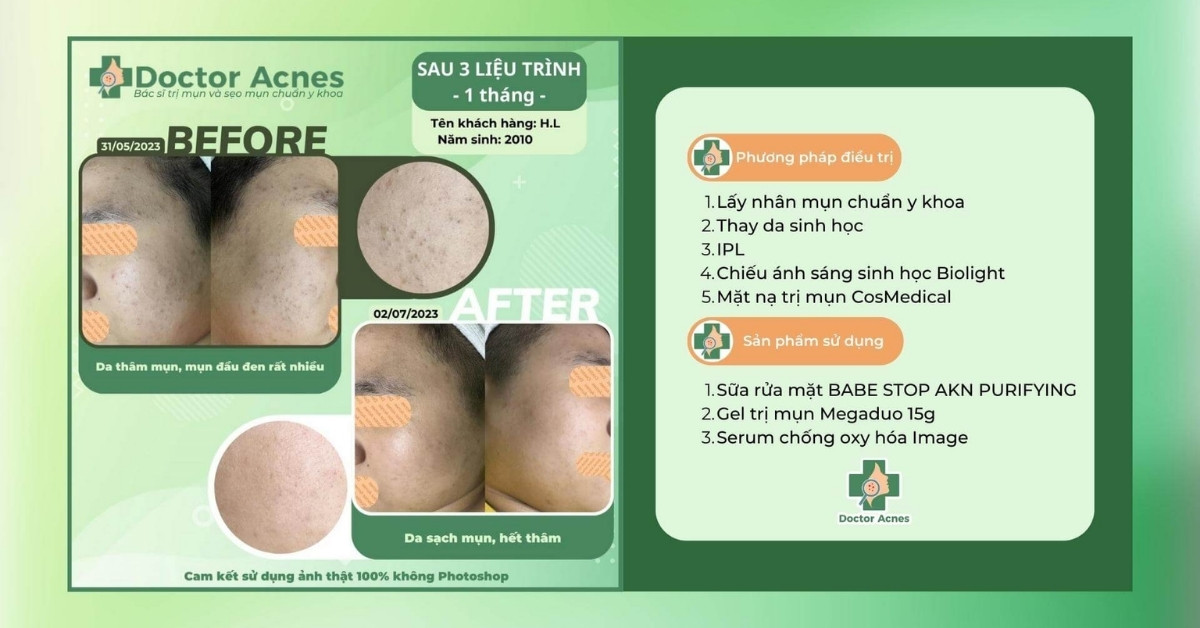 ca lâm sàng mụn