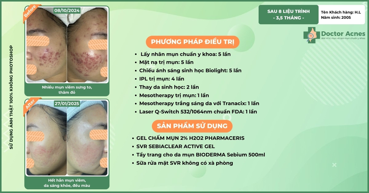ca lâm sàng mụn