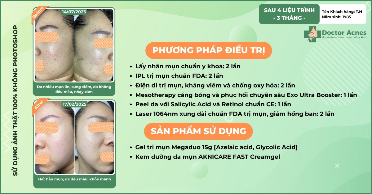 ca lâm sàng mụn