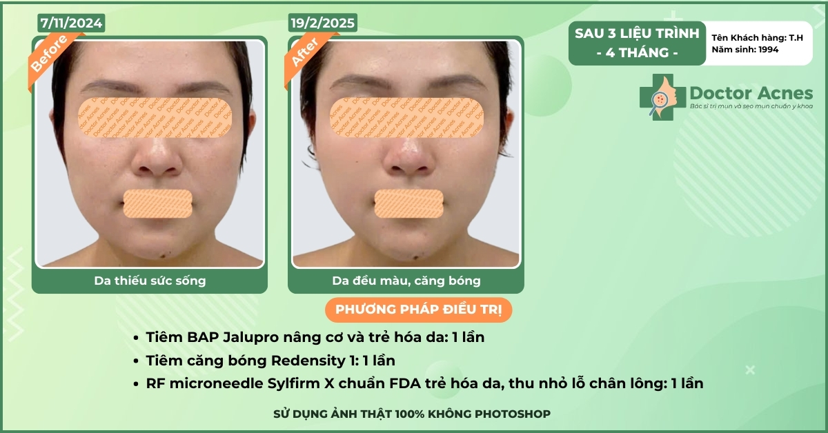 ca lâm sàng tiêm trẻ hóa thành công