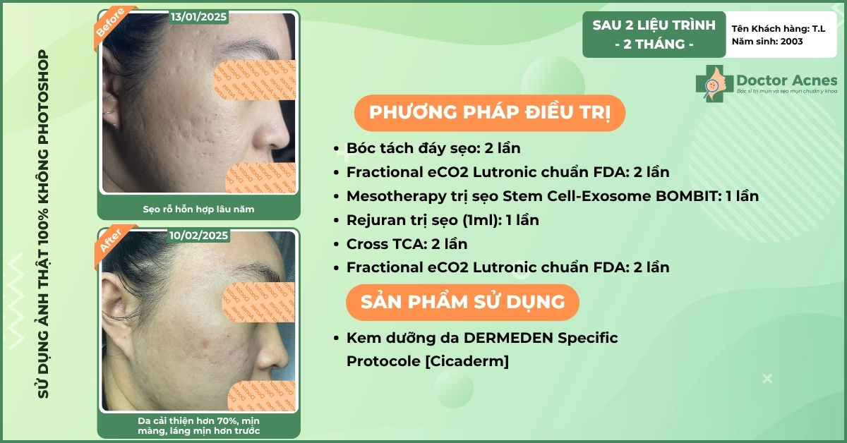ca lâm sàng trị sẹo thành công tại doctor acnes