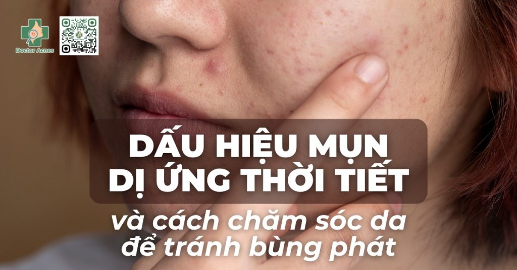 cách chăm da khi bị mụn dị ứng thời tiết