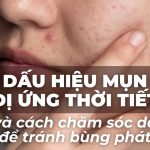 Dấu hiệu mụn dị ứng thời tiết và cách chăm sóc da để tránh bùng phát