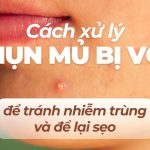 Cách xử lý mụn mủ bị vỡ để tránh nhiễm trùng và để lại sẹo