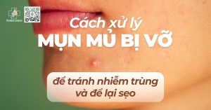 cách xử lý mụn mủ bị vỡ