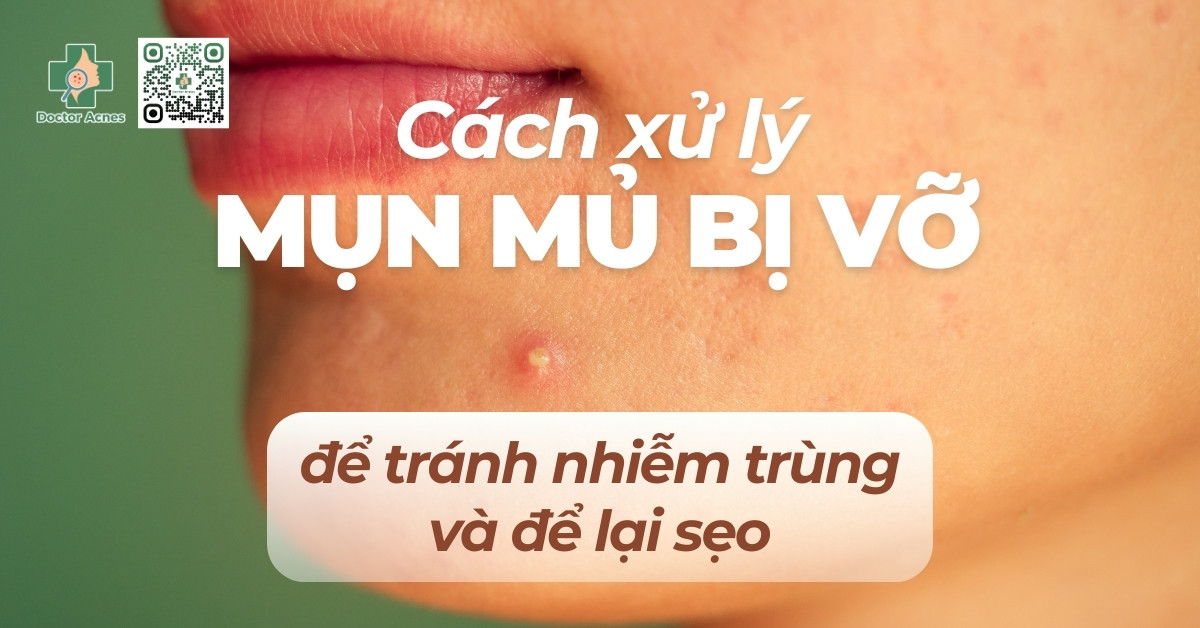 cách xử lý mụn mủ bị vỡ