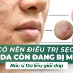 Có nên điều trị sẹo khi da còn đang bị mụn? Bác sĩ Da liễu giải đáp