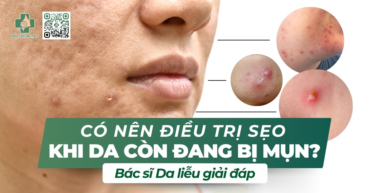 Có nên điều trị sẹo khi da còn đang bị mụn?