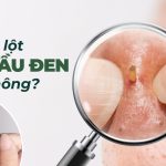 Có nên lột mụn đầu đen ở mũi không?