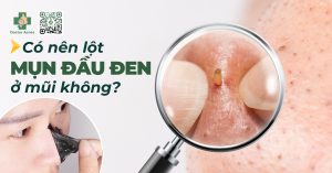 có nên lột mụn đầu đen ở mũi không