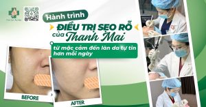 hành trình điều trị sẹo rỗ của thanh mai