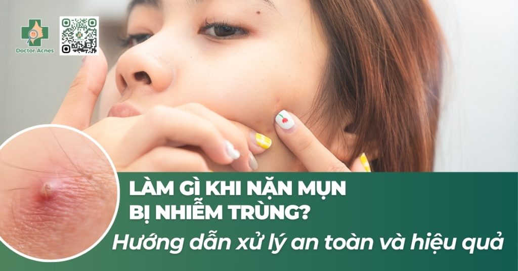 làm gì khi nặn mụn bị nhiễm trùng
