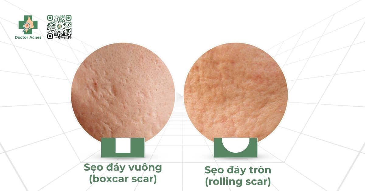 laser fractional co2 hiệu quả trong điều trị sẹo rỗ