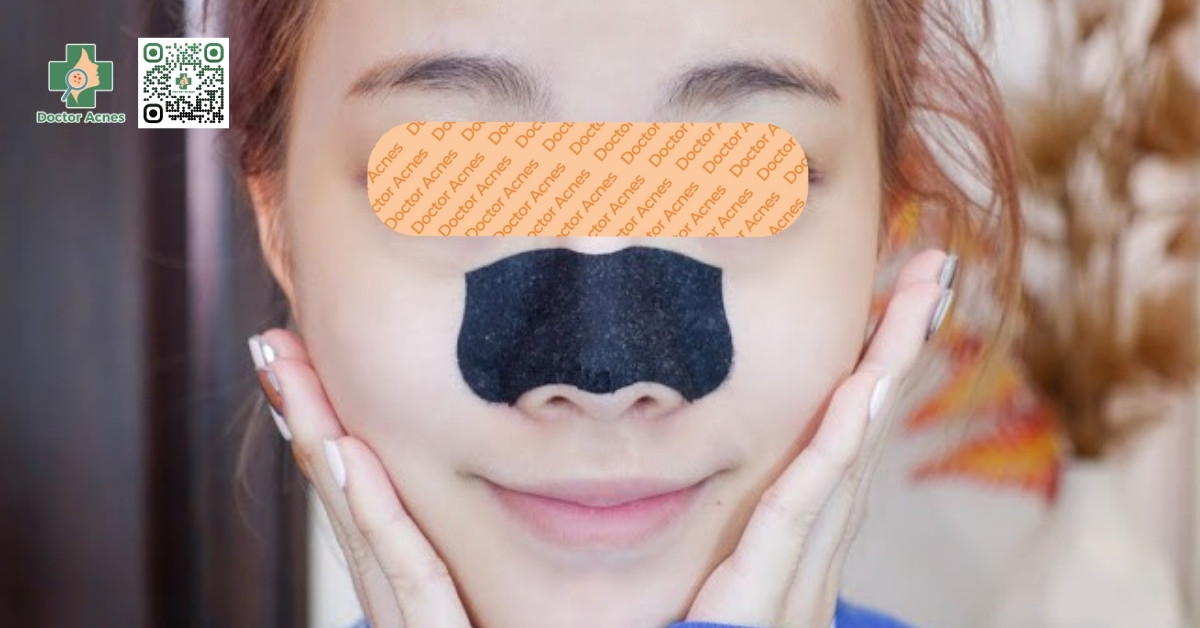 có nên lột mụn đầu đen ở mũi