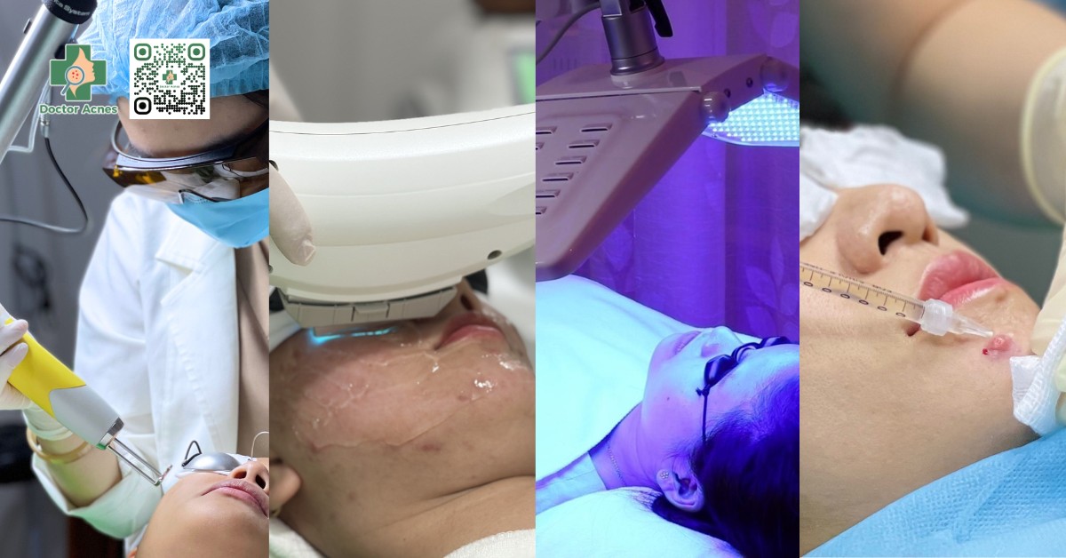 một số phương pháp điều trị mụn