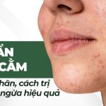 Mụn ẩn dưới cằm: nguyên nhân, cách trị và phòng ngừa hiệu quả