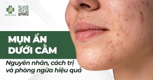 mụn ẩn dưới cằm nguyên nhân và cách trị