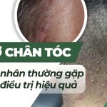 Mụn ở chân tóc: nguyên nhân thường gặp và cách điều trị hiệu quả