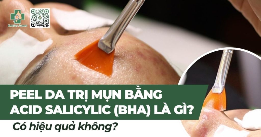 peel da trị mụn bằng acid salicylic