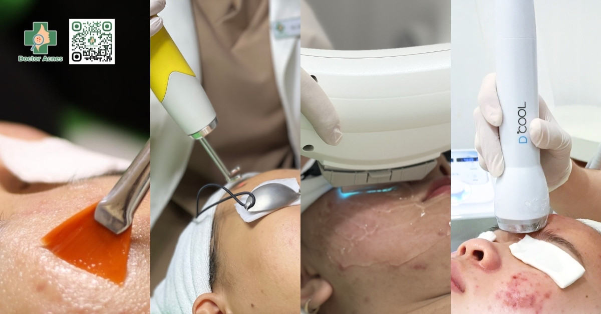 phương pháp trị mụn ở chân tóc