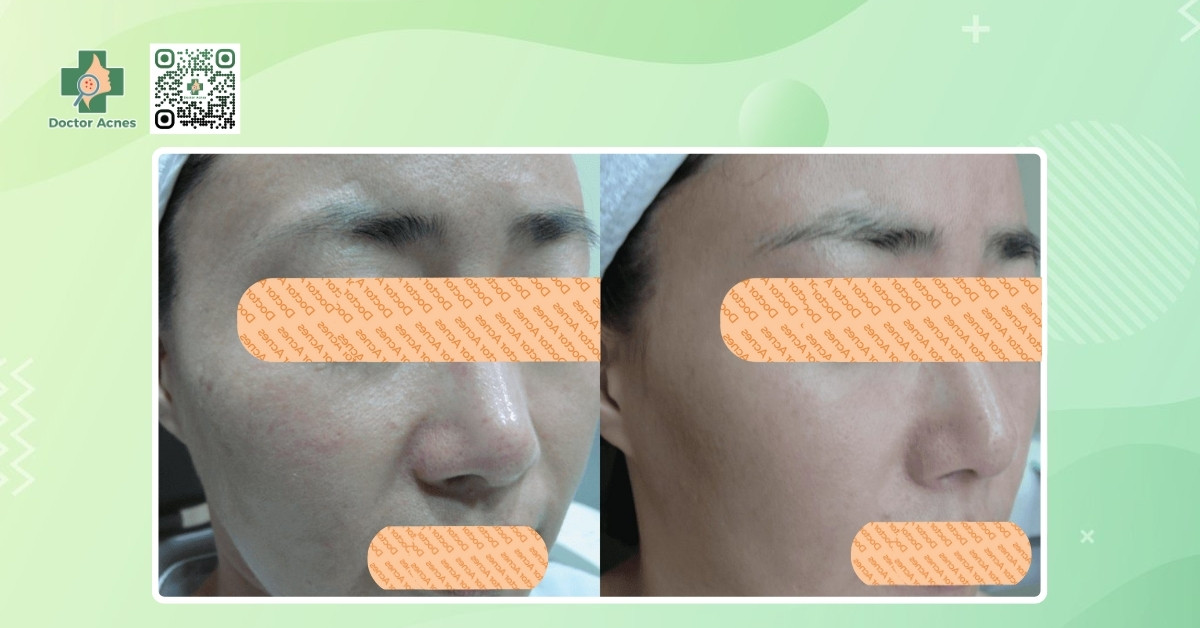 rejuran s trong điều trị sẹo rỗ