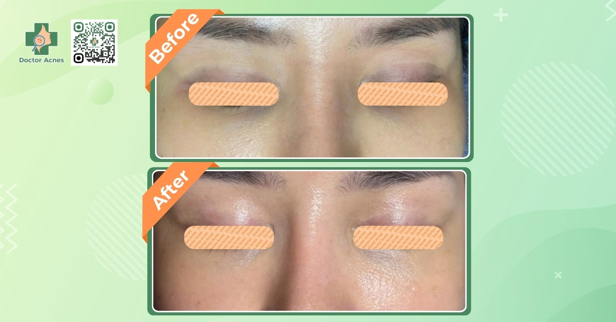 tiêm trẻ hóa da mắt thành công tại doctor acnes