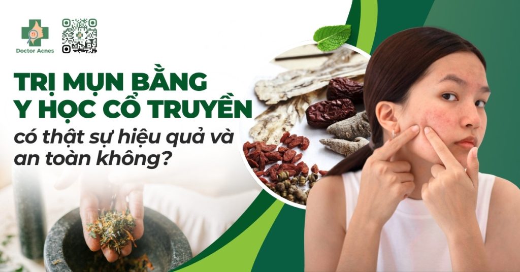 trị mụn bằng y học cổ truyền hiệu quả an toàn