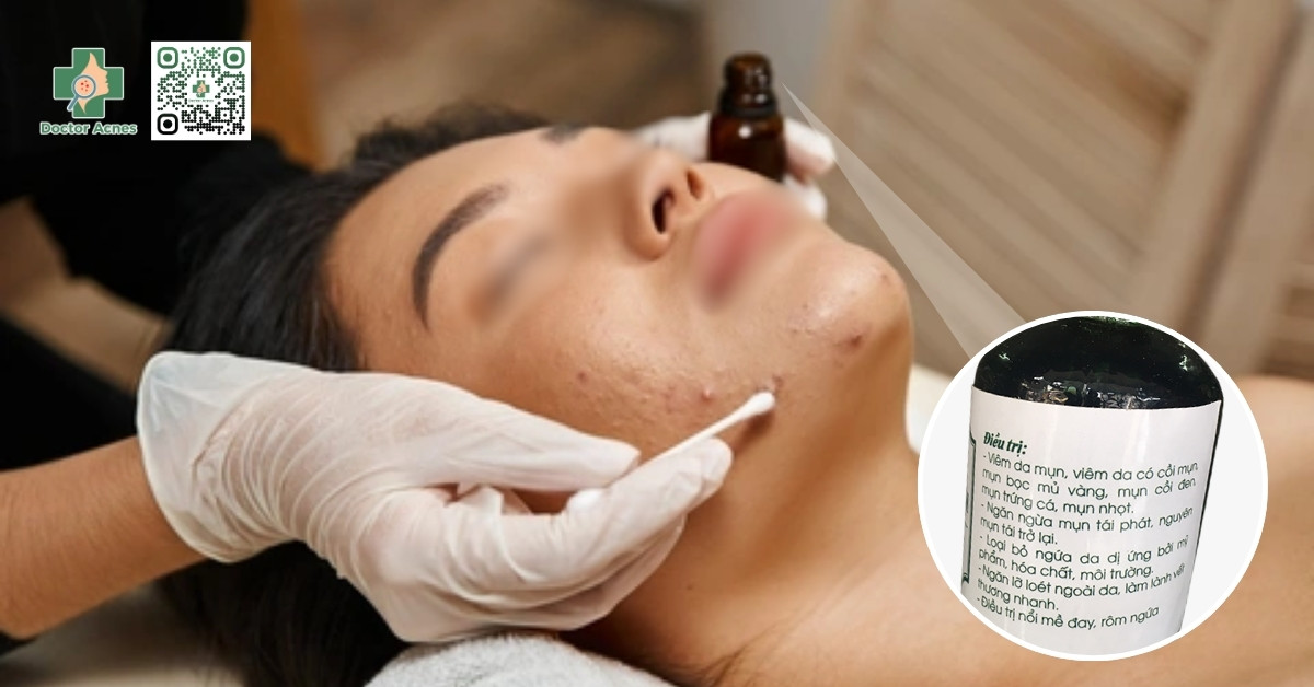 trị mụn bằng y học cổ truyền