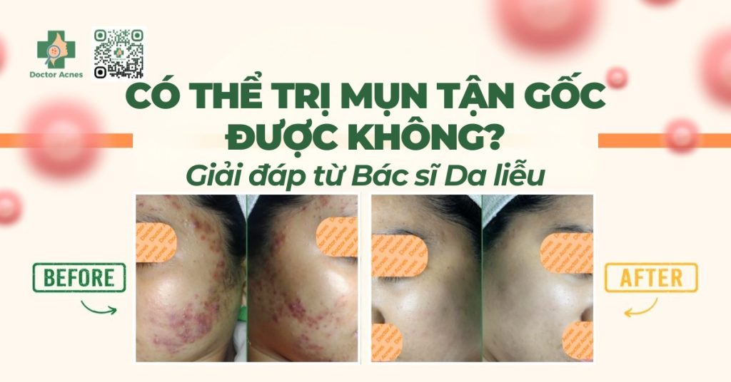 Có thể trị mụn tận gốc được không? Giải đáp từ Bác sĩ Da liễu