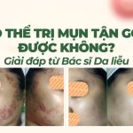 Có thể trị mụn tận gốc được không? Giải đáp từ Bác sĩ Da liễu