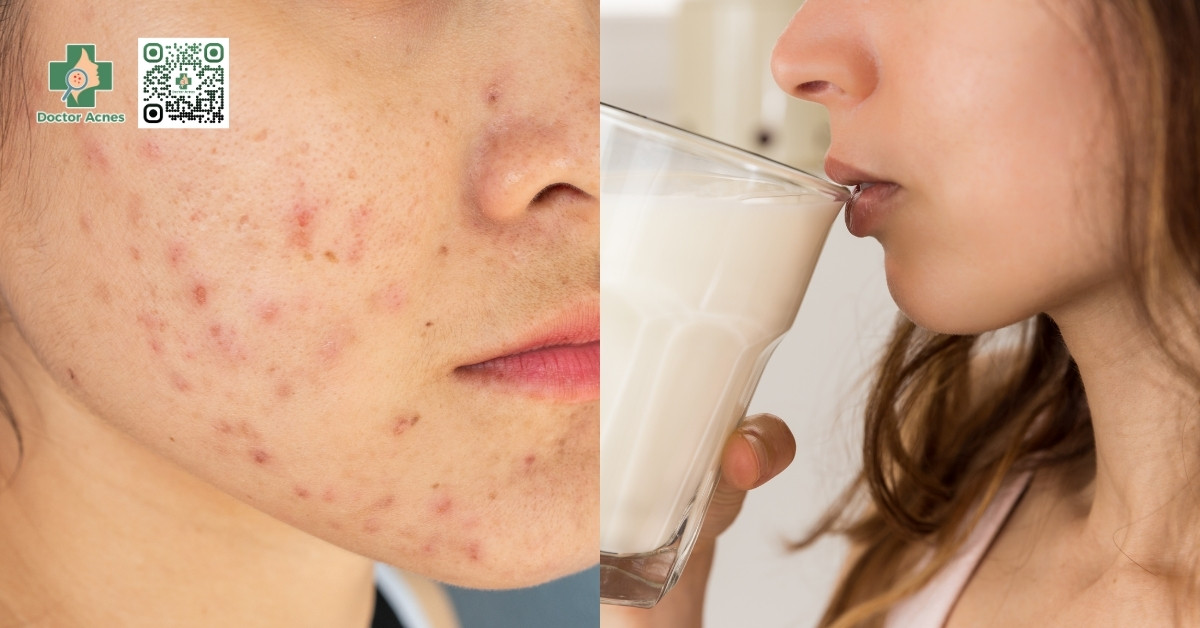 uống whey có lên mụn không