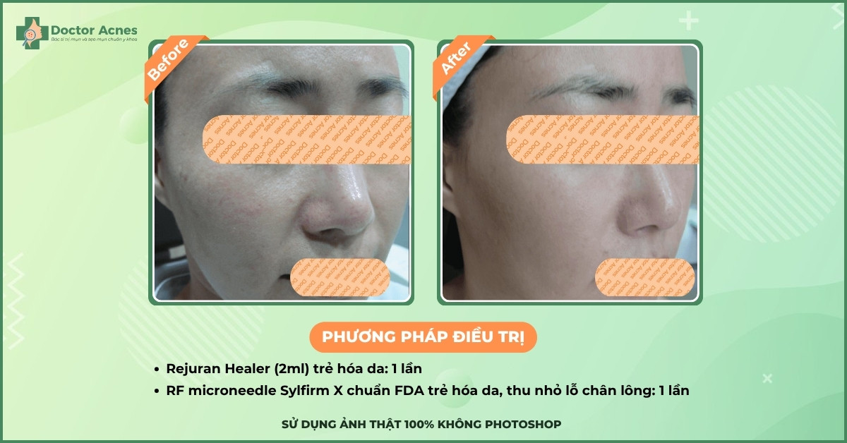cls tiêm rejuran healer tại doctor acnes