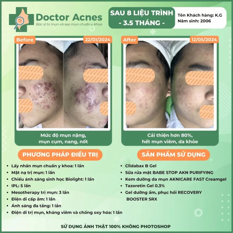 Hiệu quả điều trị mụn Doctor Acnes 2025 CLS mụn 10