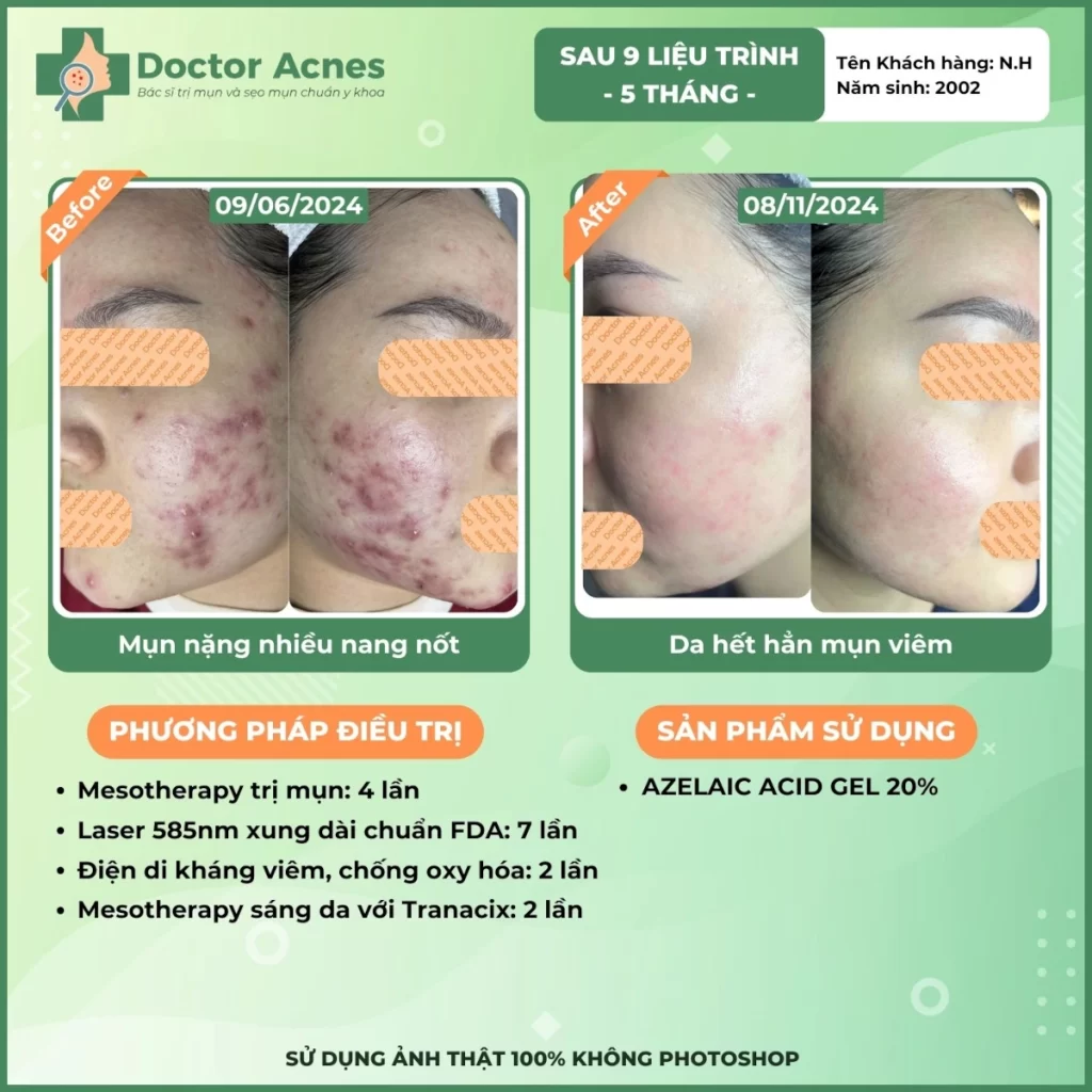 Hiệu quả điều trị mụn Doctor Acnes 2025 CLS mụn 15