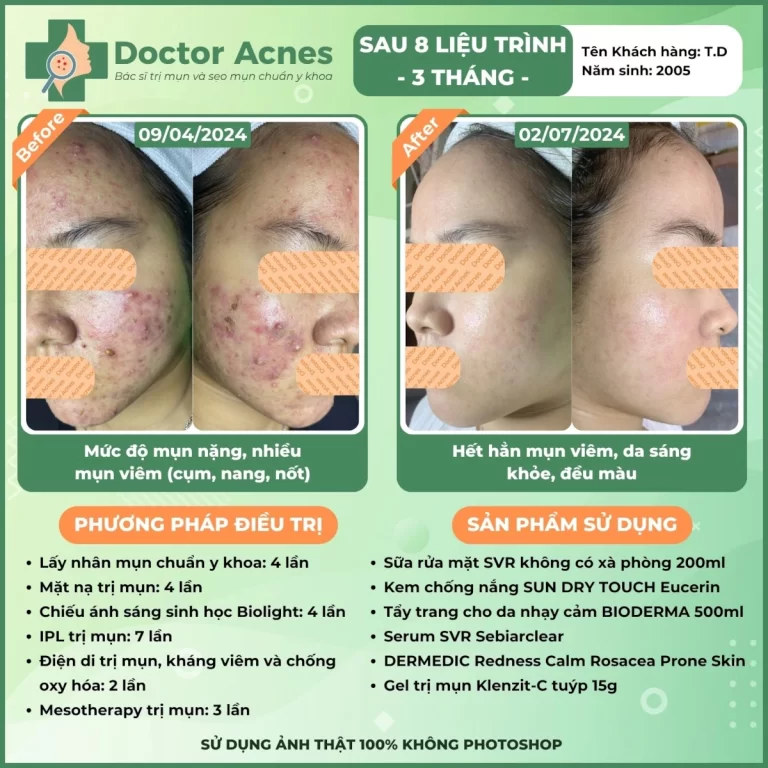 Hiệu quả điều trị mụn Doctor Acnes 2025 CLS mụn 16