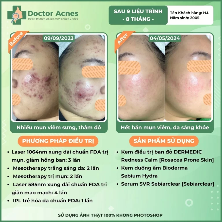 Hiệu quả điều trị mụn Doctor Acnes 2025 CLS mụn 21