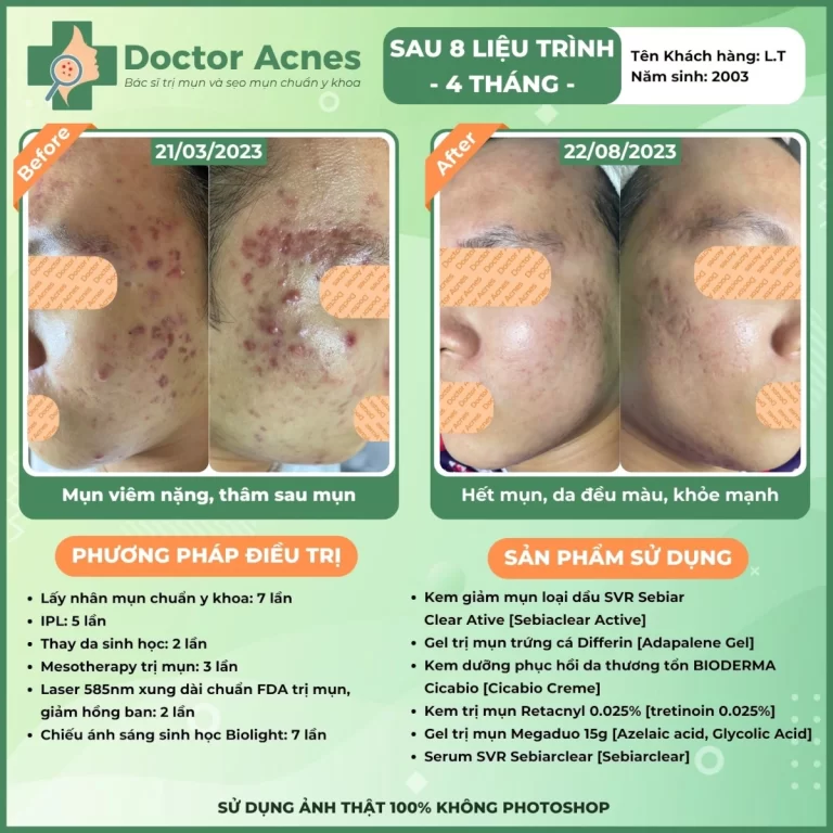 Hiệu quả điều trị mụn Doctor Acnes 2025 CLS mụn 27