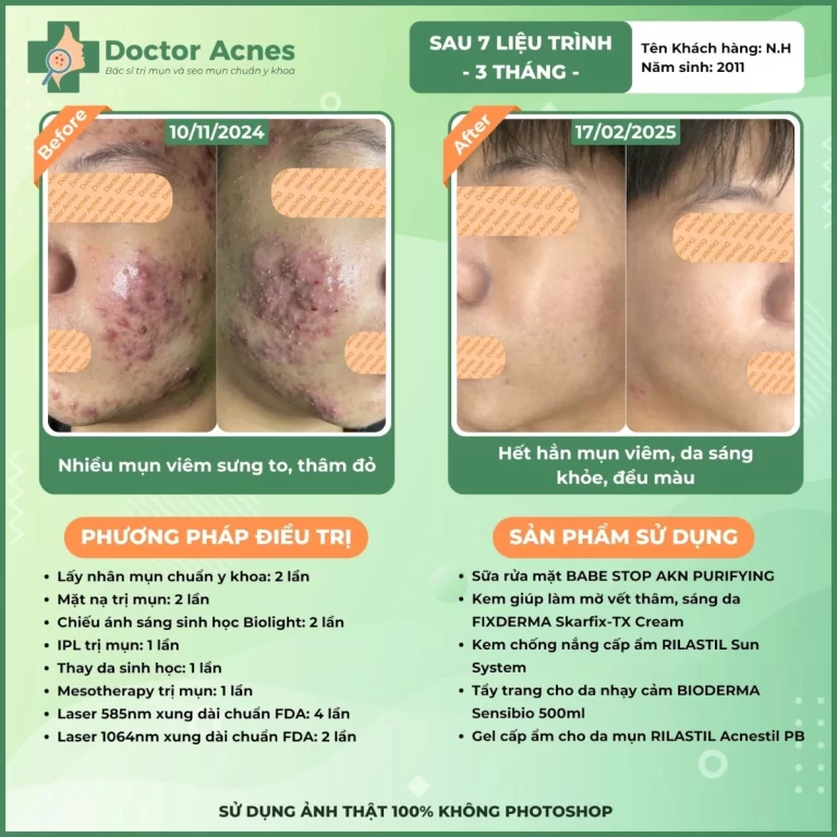 Hiệu quả điều trị mụn Doctor Acnes 2025 CLS mụn 28