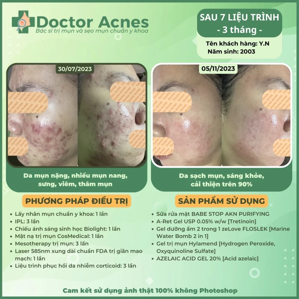 Hiệu quả điều trị mụn Doctor Acnes 2025 CLS mụn 43