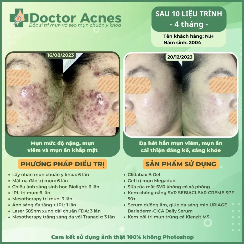 Hiệu quả điều trị mụn Doctor Acnes 2025 CLS mụn 44