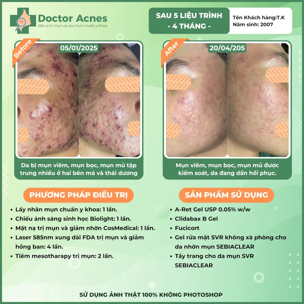 Hiệu quả điều trị mụn Doctor Acnes 2025 CLS mụn 7