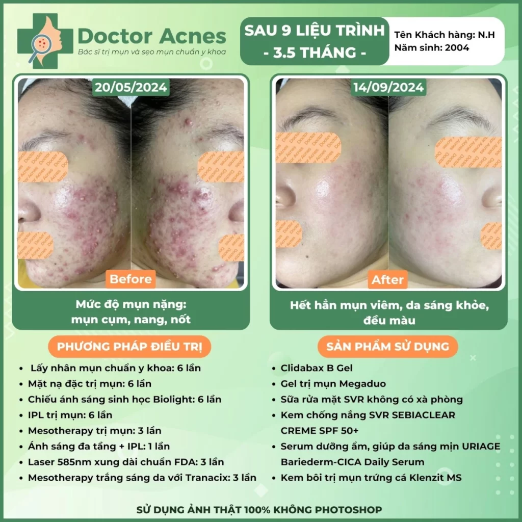 Hiệu quả điều trị mụn Doctor Acnes 2025 CLS mụn 8