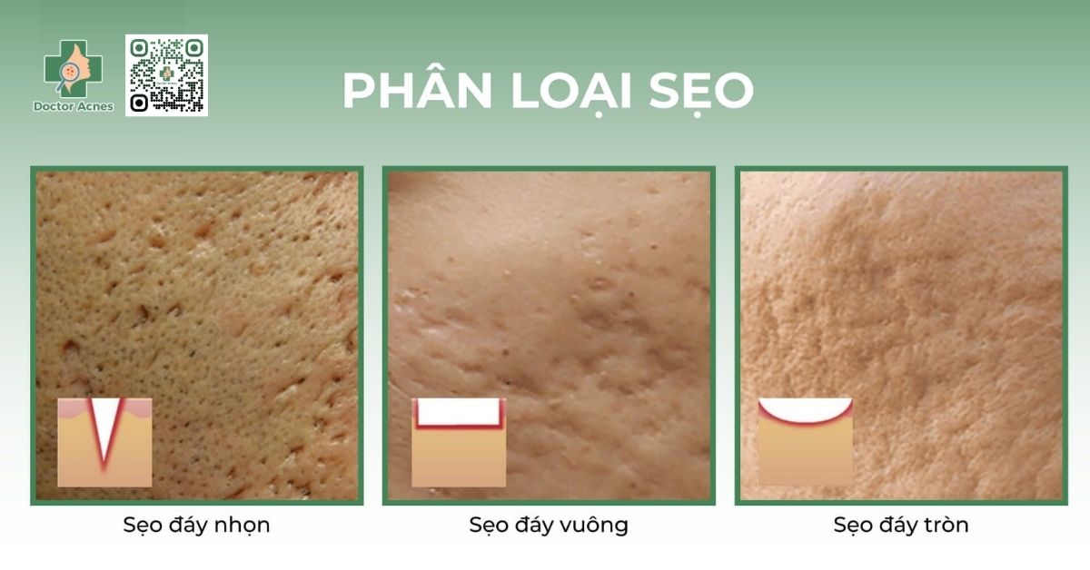 các loại sẹo