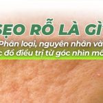 Sẹo lõm là gì? Phân loại, nguyên nhân và phác đồ điều trị từ góc nhìn mô học